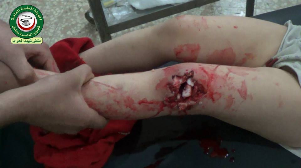 نداء مناشدة لعلاج طفلة أصيبت في الاشتباكات الأخيرة في مخيم اليرموك 