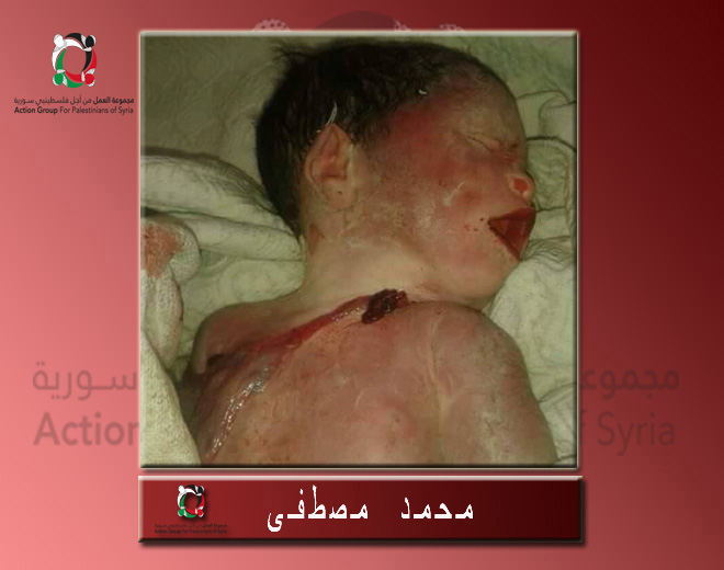 وفاة طفل من أبناء مخيم اليرموك نتيجة الحصار ونقص الرعاية الطبية 