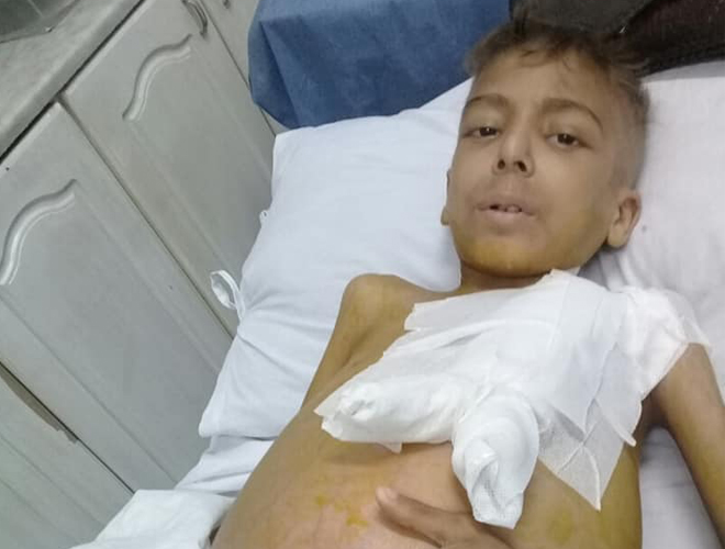 مناشدات للتكفل بعلاج طفل فلسطيني سوري مصاب بمرض "الذأب الحمامي"