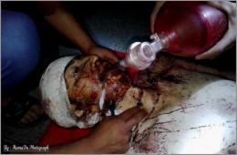 قضاء أحد أبناء مخيم اليرموك المحاصرين متأثراً بجراح أصيب بها في قصف يوم أمس
