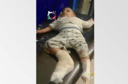 إصابة طفل رضيع (6 أشهر) جراء قصف قوات النظام على مخيم اليرموك 