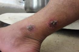 ناشطون: انتشار مرض "ليشمانيا" بين المهجرين في مخيم دير بلوط