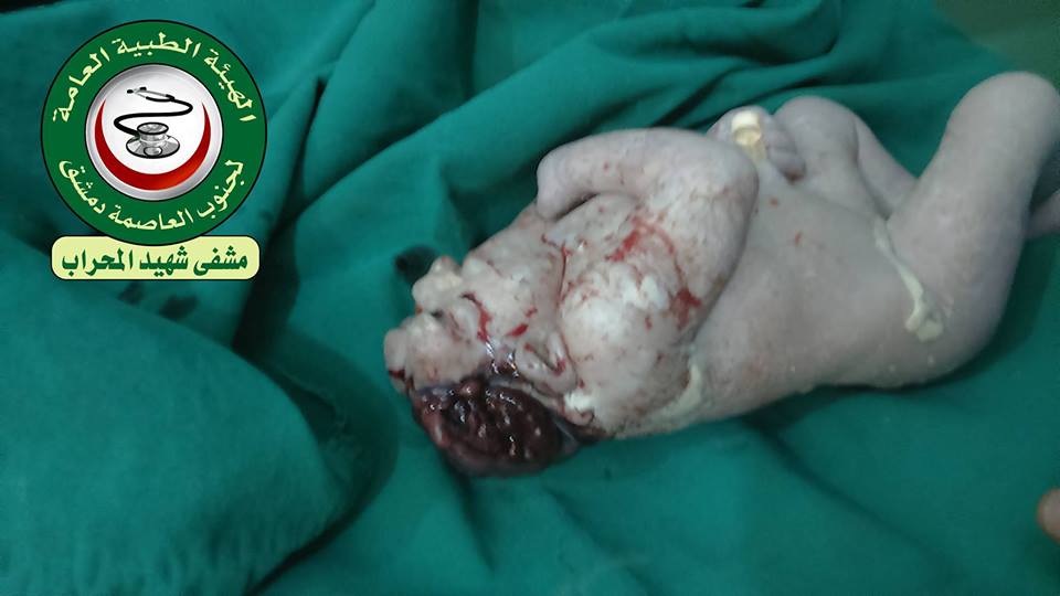 A Number of Embryonic Deformities in Yarmouk and South Area in Damascus
