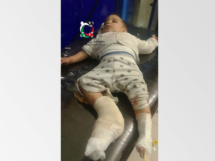 A 6-month-old infant injured amid the regime forces’ bombardment of Yarmouk camp