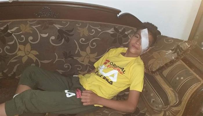 Children in AlNeirab Camp for Palestinian Refugees Sustain Eye Injuries 